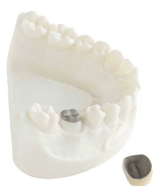 Crown and Bridgework - Non Metal - Post and Core