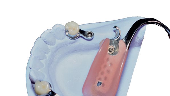 Extradental Attachments precision attachements