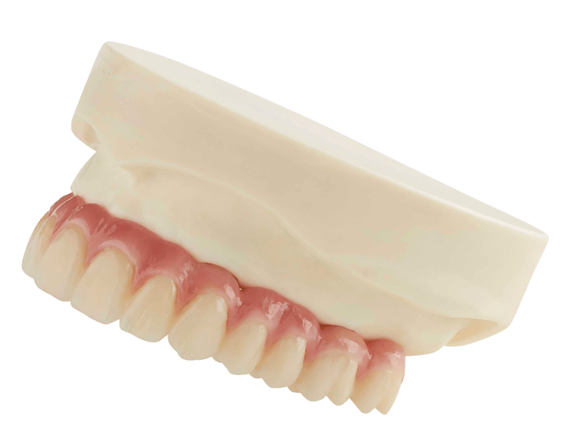 overdentures on an angle