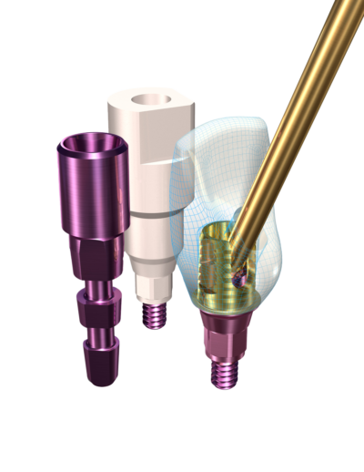 direct dental implant