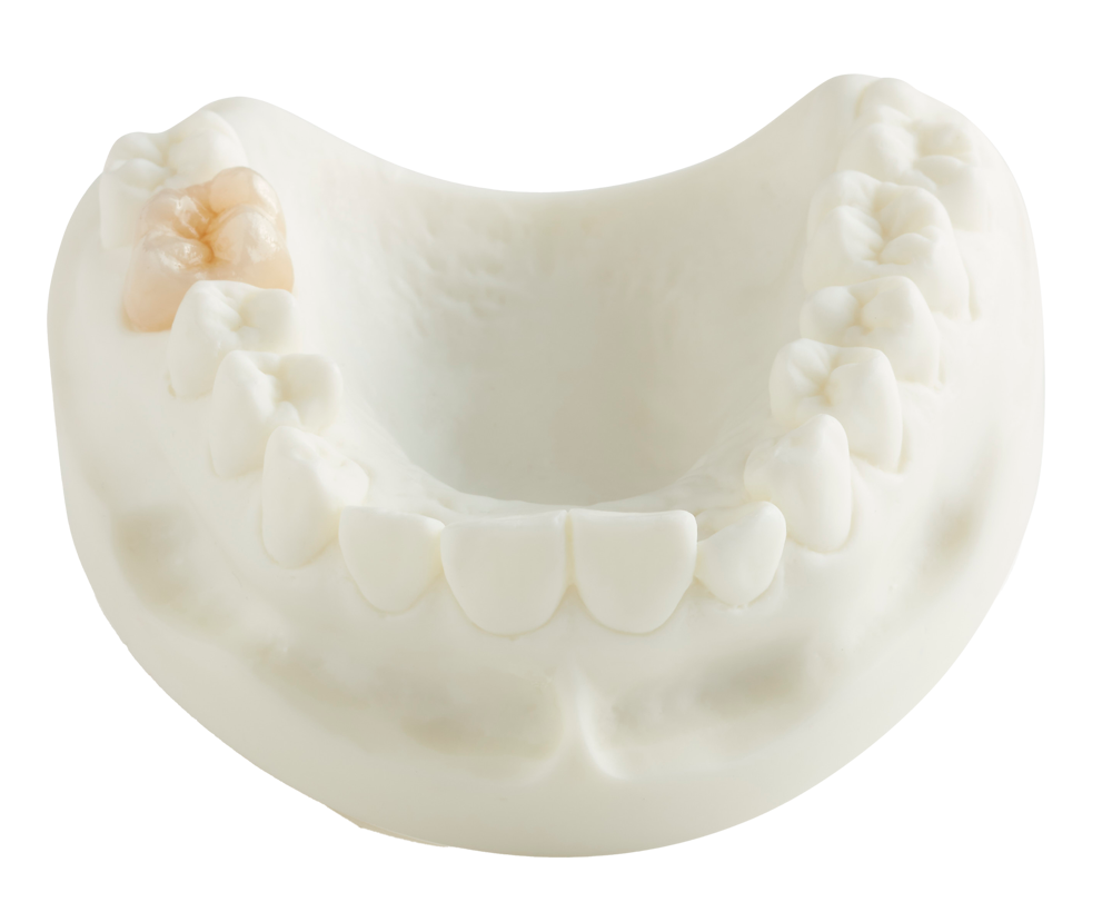 Zirconia Dental Crowns & Bridgework Southern Cross Dental