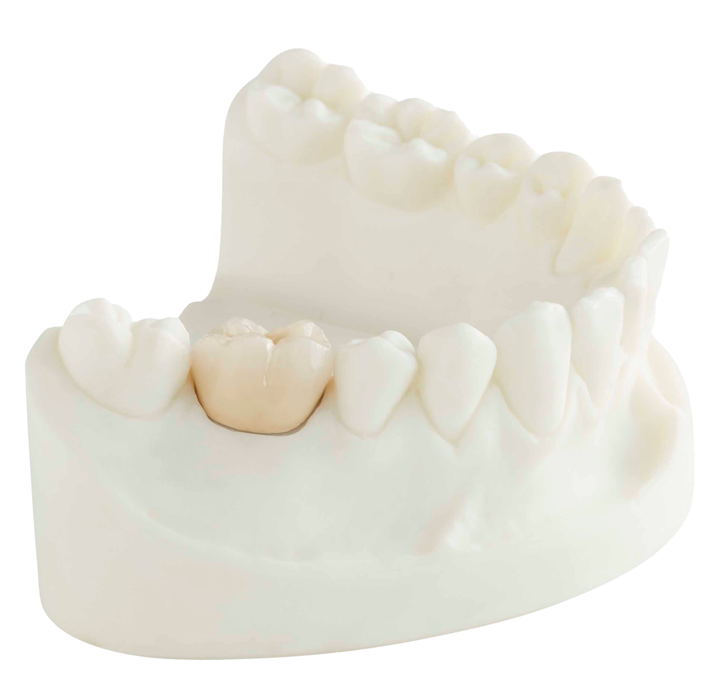 Metal-Ceramic | PFM Crown | Southern Cross Dental